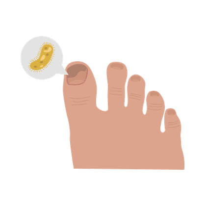 Champignons des ongles (onychomycose) et champignons des pieds (pied d'athlète)