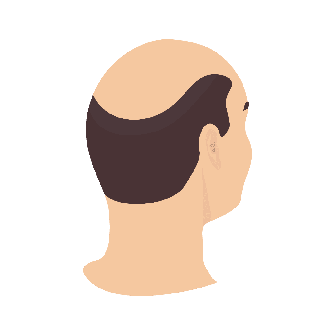 Alopécie (calvitie, perte de cheveux)