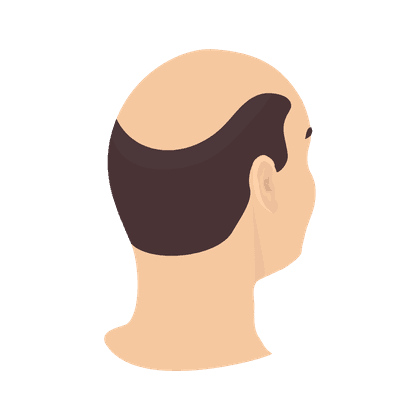 Alopécie (calvitie, perte de cheveux)