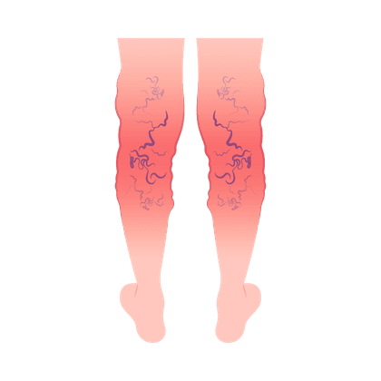 Varices