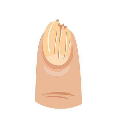 Onycholyse (séparation de la plaque de l'ongle)