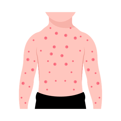 Varicelle